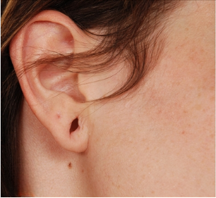 Ear Loby Repair